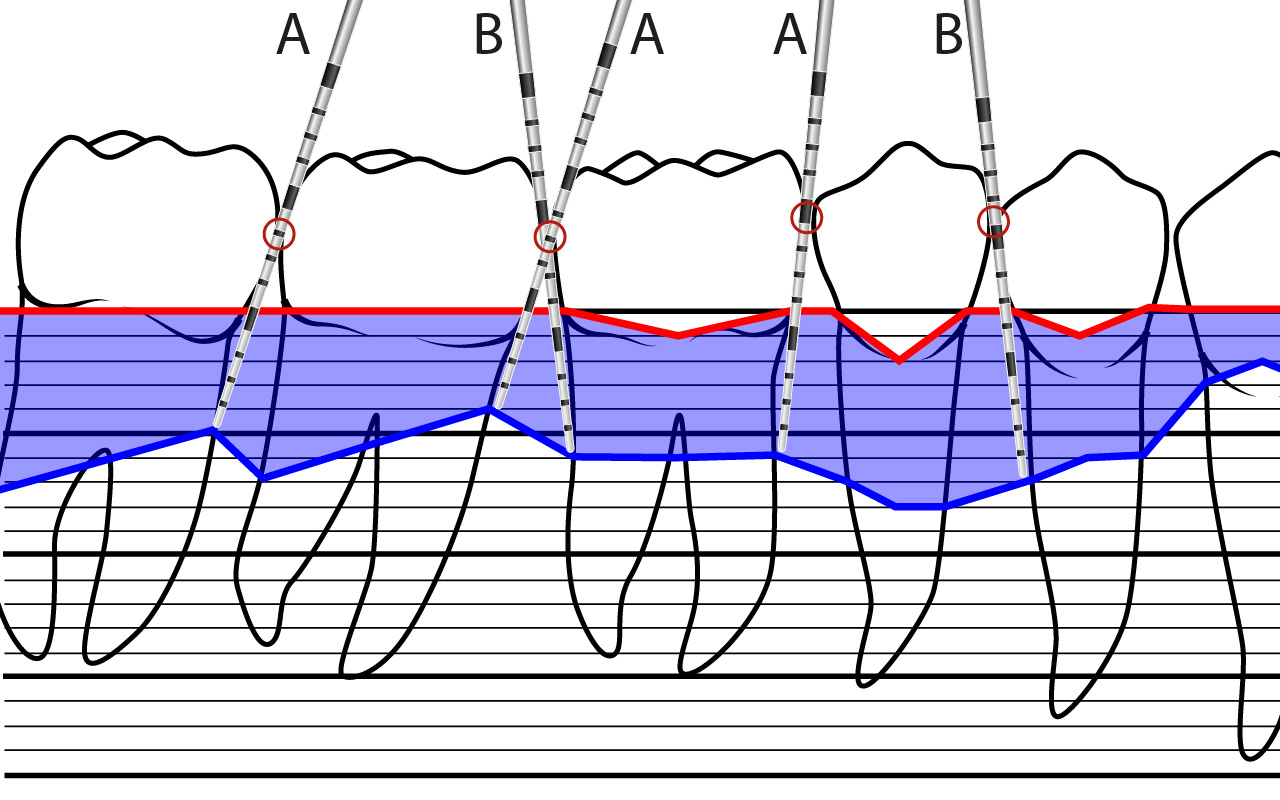 Angolazione sonda parodontale