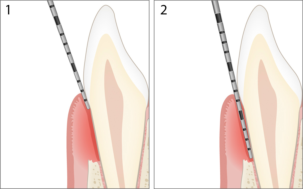 Sondaggio tasca parodontale
